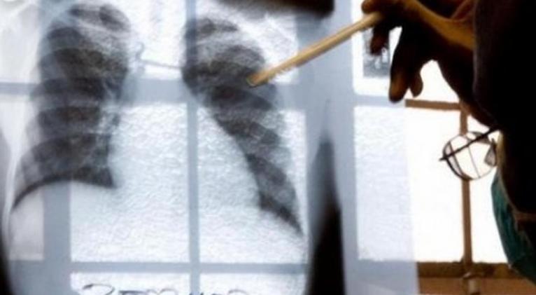 tuberculosis_1